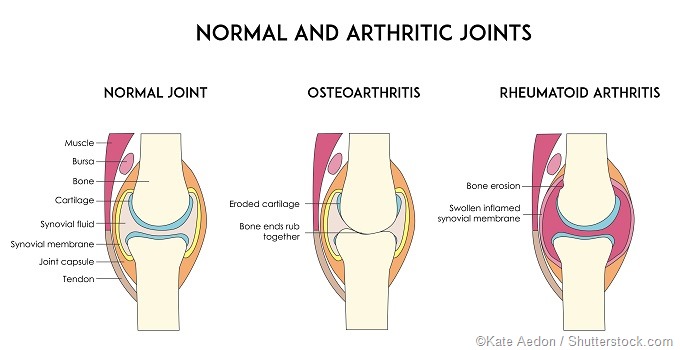 osteoarthritis rheumatoid arthritis kezelése)